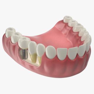 3D model Lower Teeth Medical Model With Dental Implant