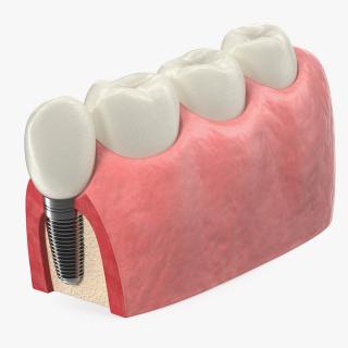 3D Education Tooth Implant model