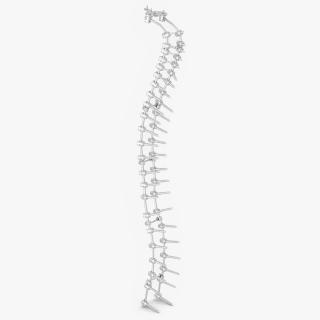 3D Spine Fixation System