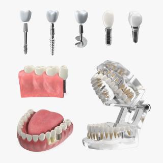 Tooth Implants Collection 2 3D