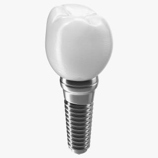 3D model Tooth Dental Implant