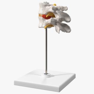 Stand with Herniated Spinal Vertebrae 3D