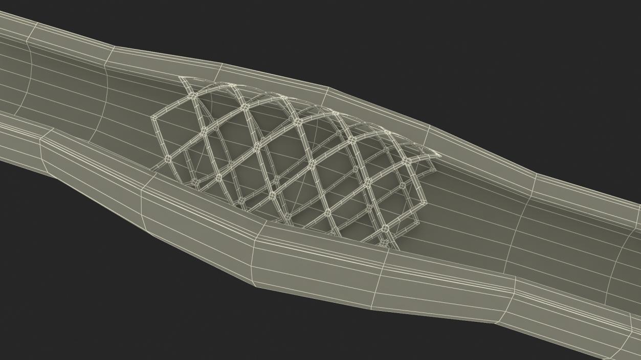 3D Plastic Models of Stents with Artery 2 model