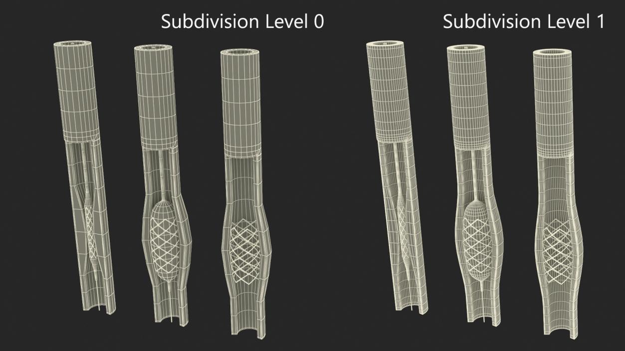 3D Plastic Models of Stents with Artery 2 model