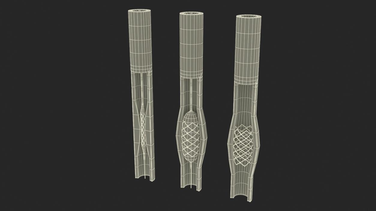 3D Plastic Models of Stents with Artery 2 model