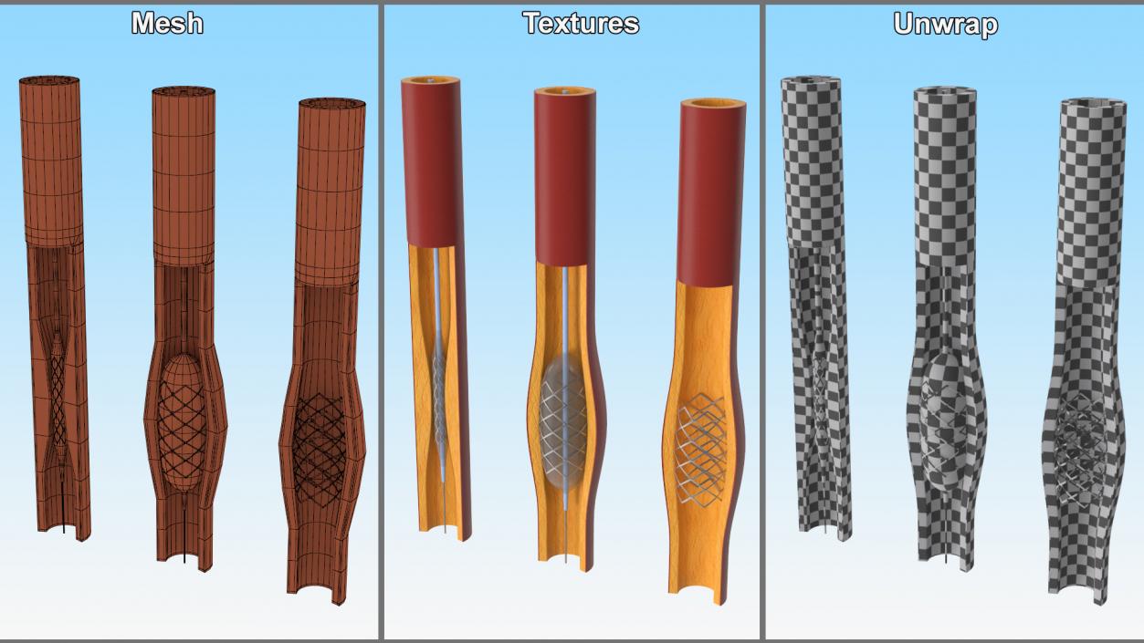 3D Plastic Models of Stents with Artery 2 model