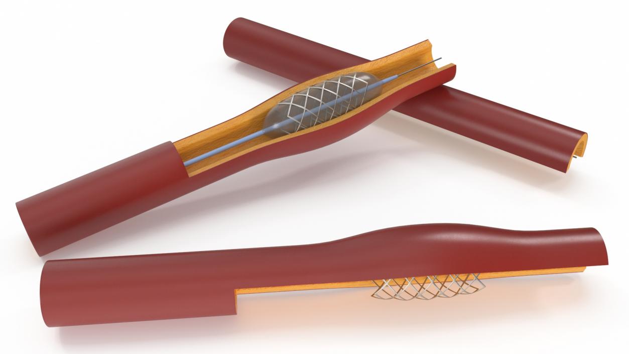 3D Plastic Models of Stents with Artery 2 model