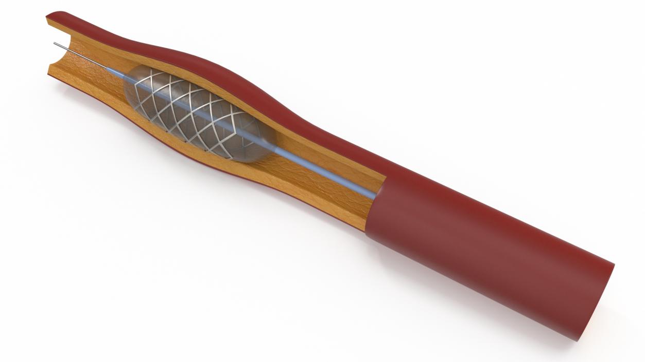 3D Plastic Models of Stents with Artery 2 model