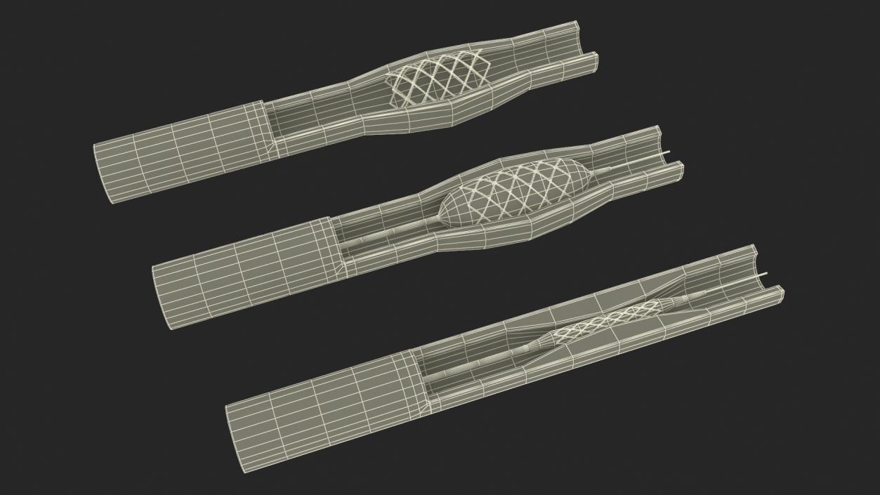 3D Plastic Models of Stents with Artery 2 model