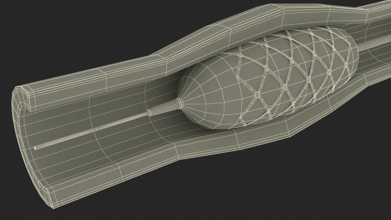 3D Plastic Models of Stents with Artery 2 model