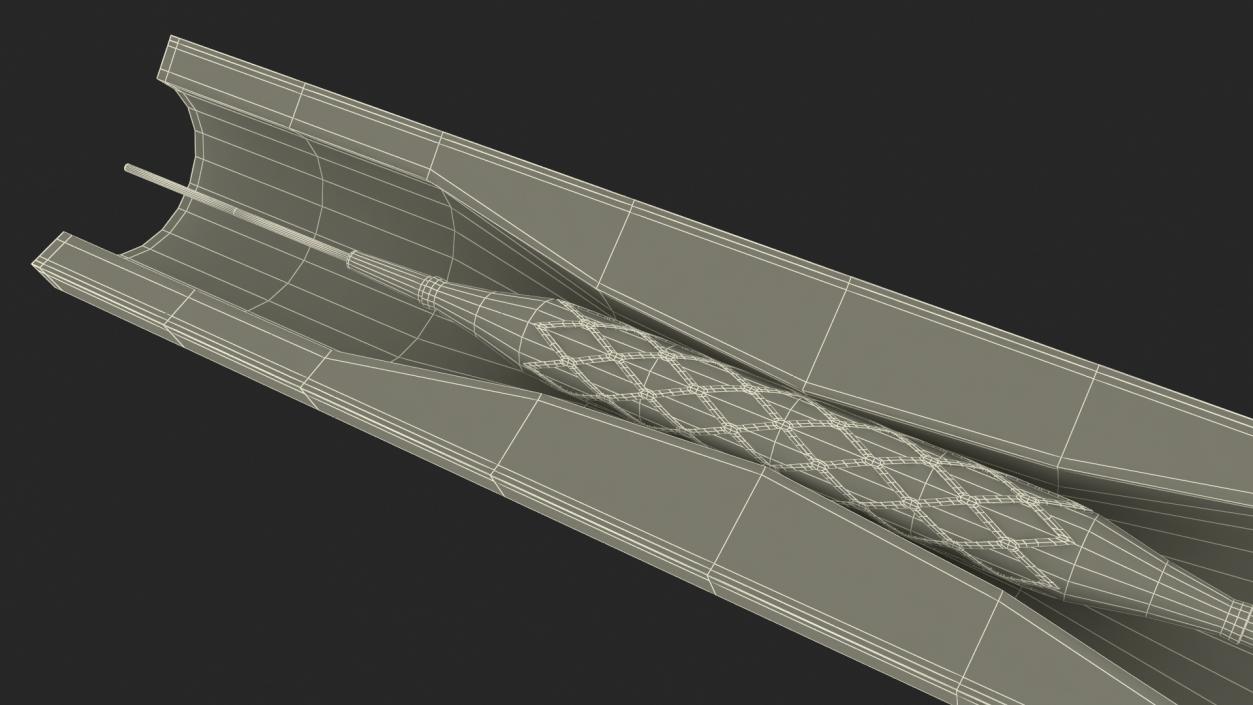 3D Plastic Models of Stents with Artery 2 model