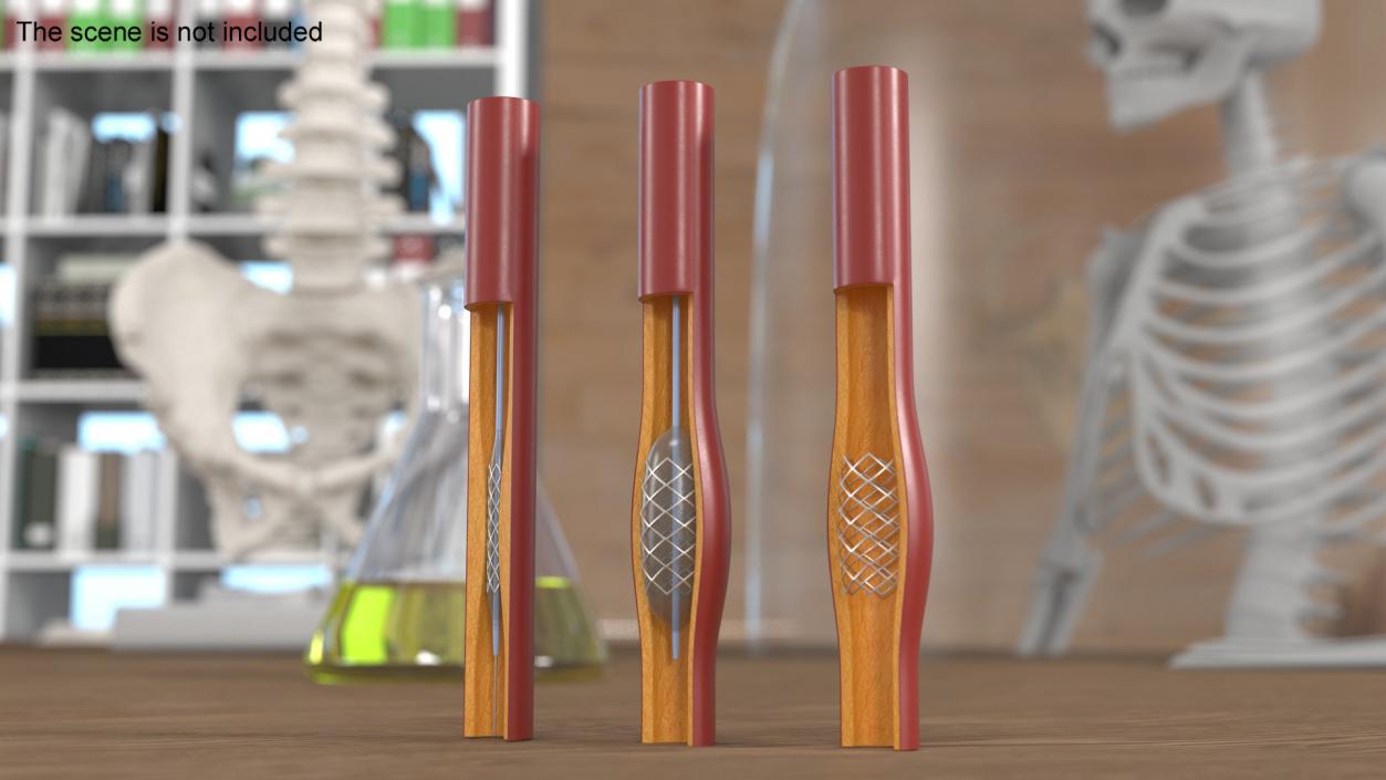 3D Plastic Models of Stents with Artery 2 model