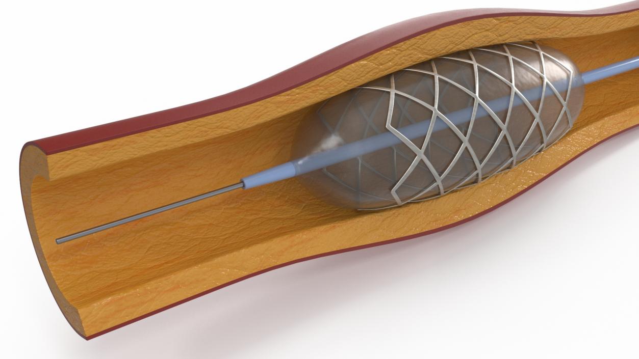 3D Plastic Models of Stents with Artery 2 model