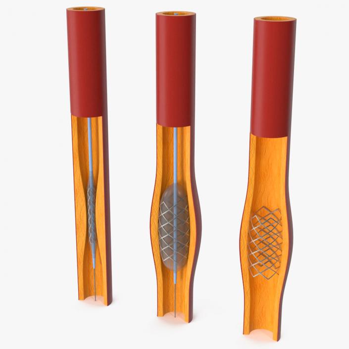 3D Plastic Models of Stents with Artery 2 model