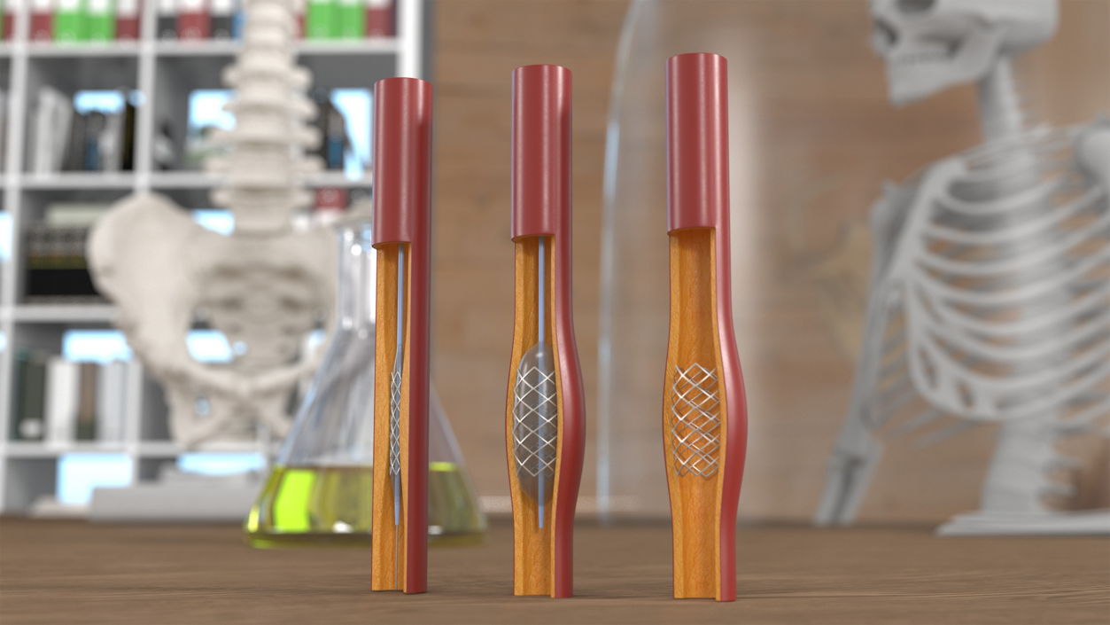 3D Plastic Models of Stents with Artery 2 model