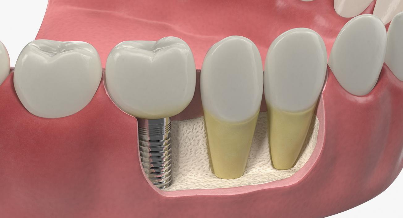 3D model Lower Teeth Medical Model With Dental Implant