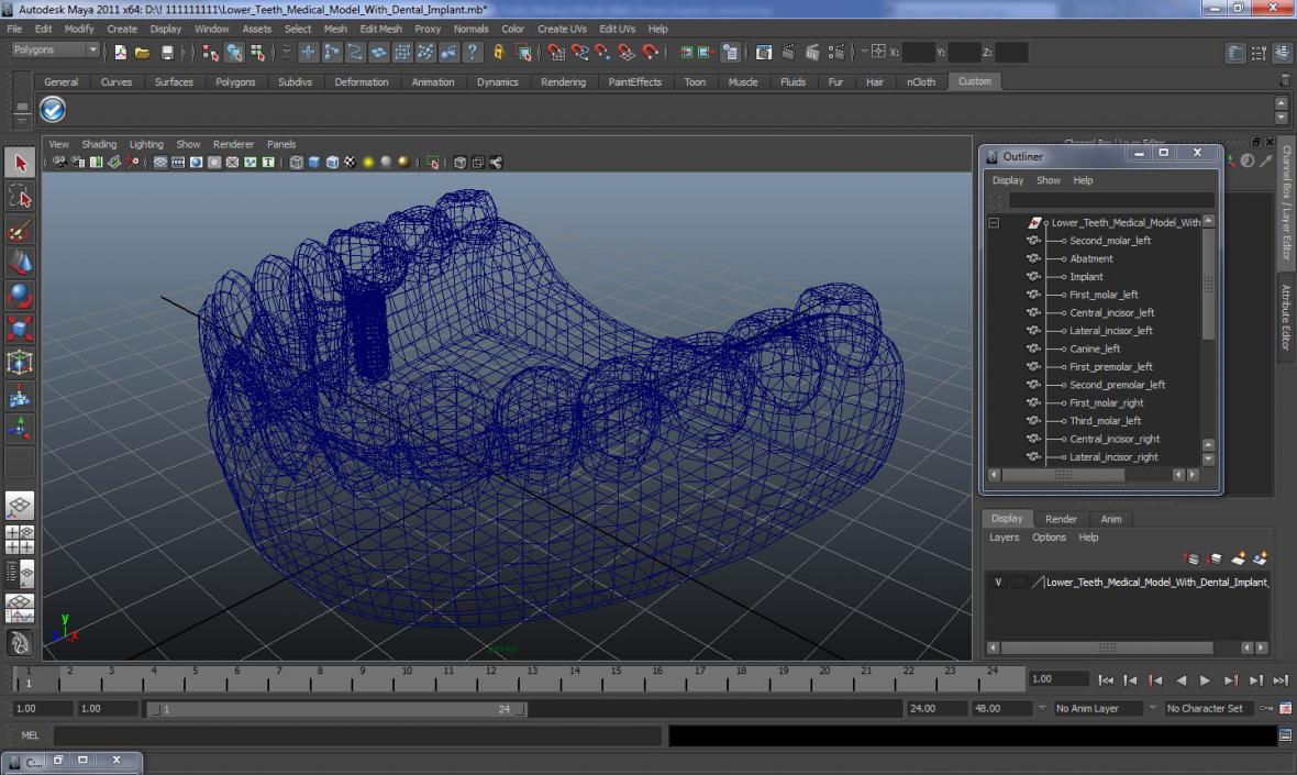 3D model Lower Teeth Medical Model With Dental Implant