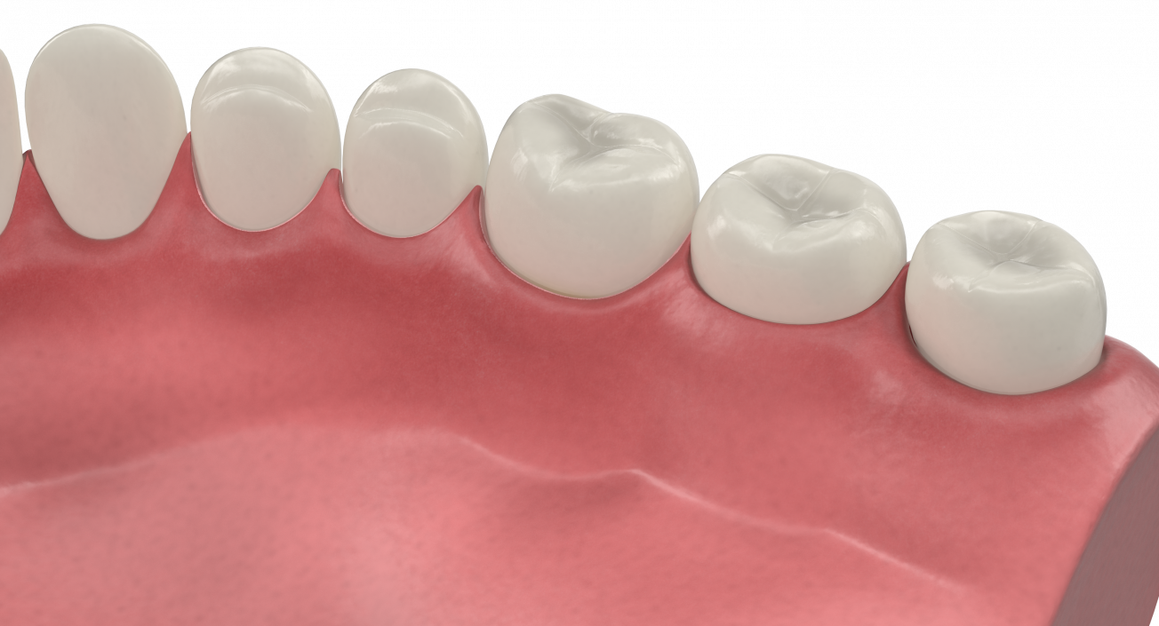 3D model Lower Teeth Medical Model With Dental Implant