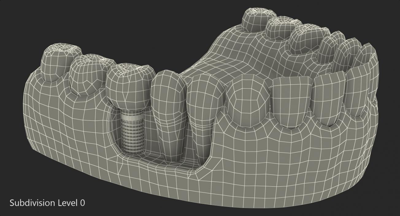 3D model Lower Teeth Medical Model With Dental Implant