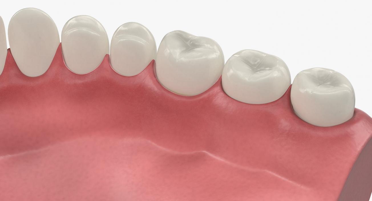 3D model Lower Teeth Medical Model With Dental Implant