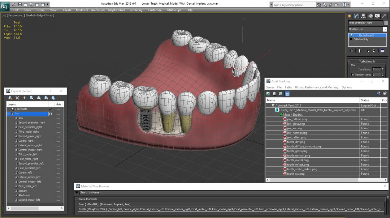 3D model Lower Teeth Medical Model With Dental Implant