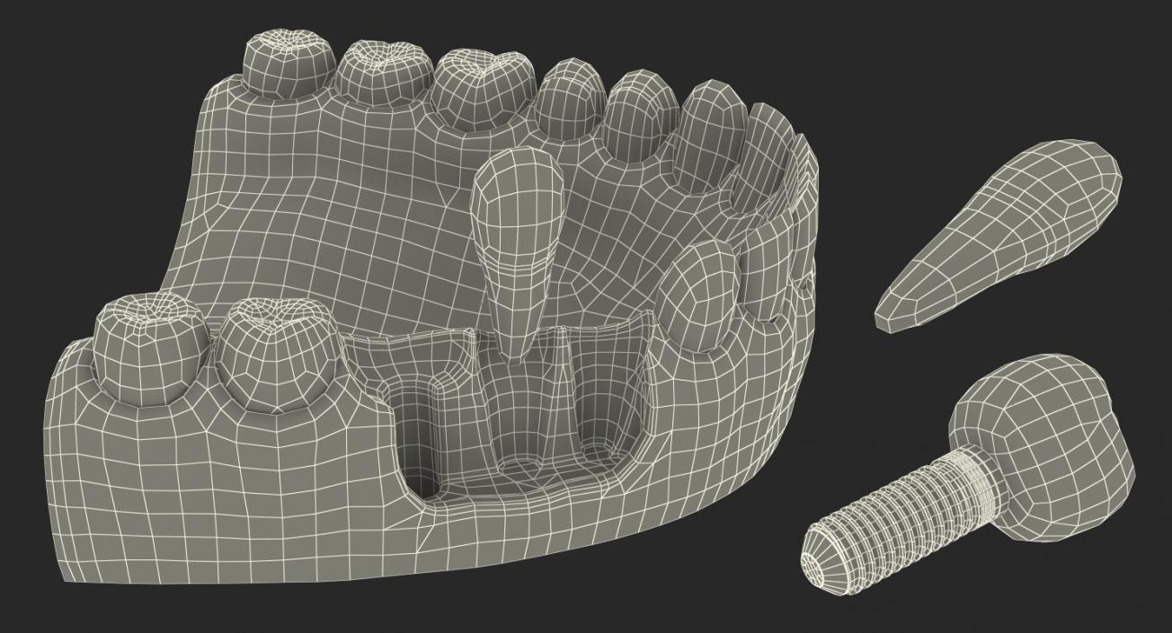 3D model Lower Teeth Medical Model With Dental Implant