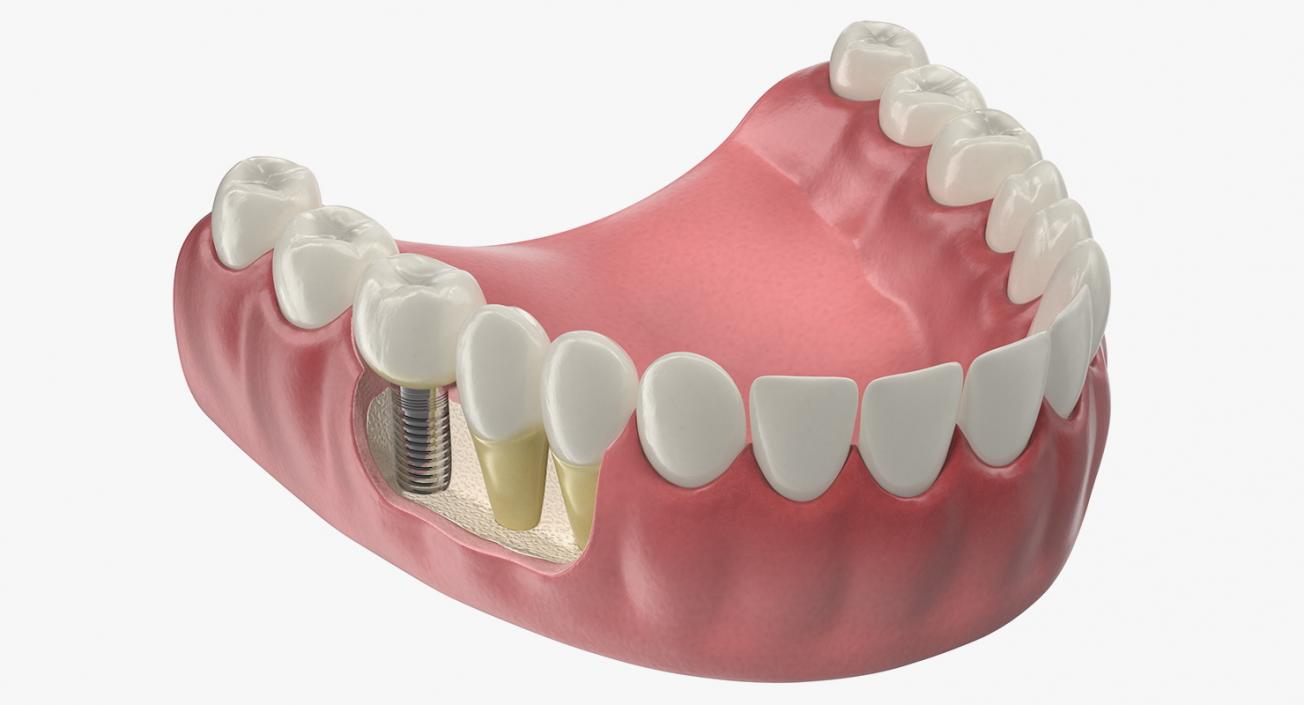 3D model Lower Teeth Medical Model With Dental Implant