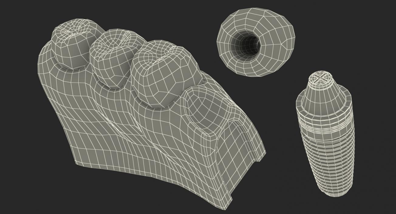 3D Education Tooth Implant model