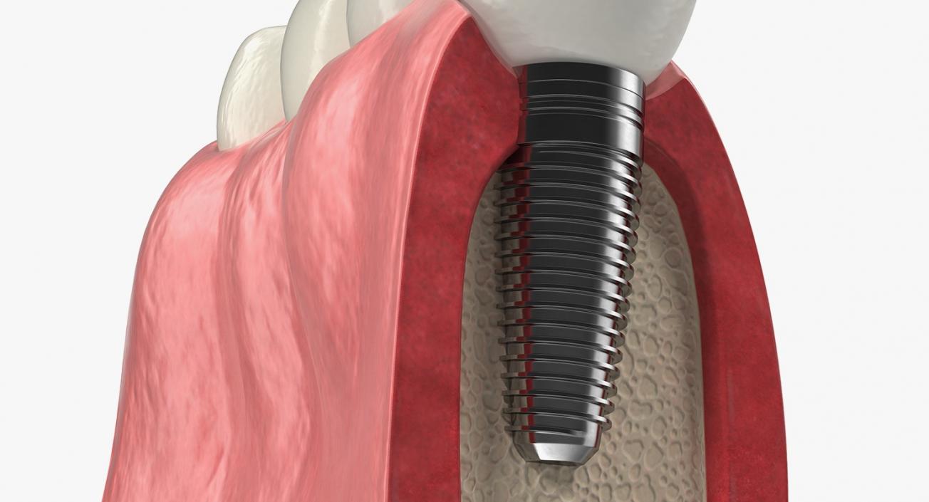 3D Education Tooth Implant model