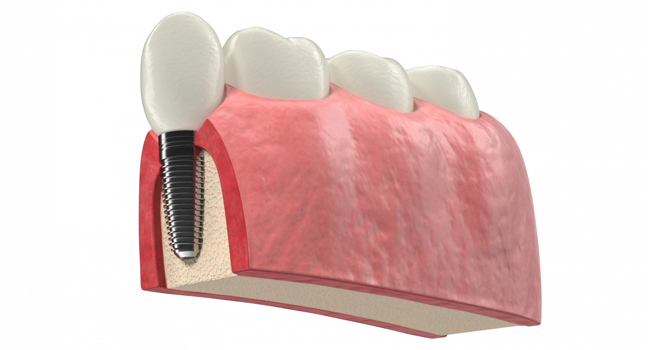 3D Education Tooth Implant model