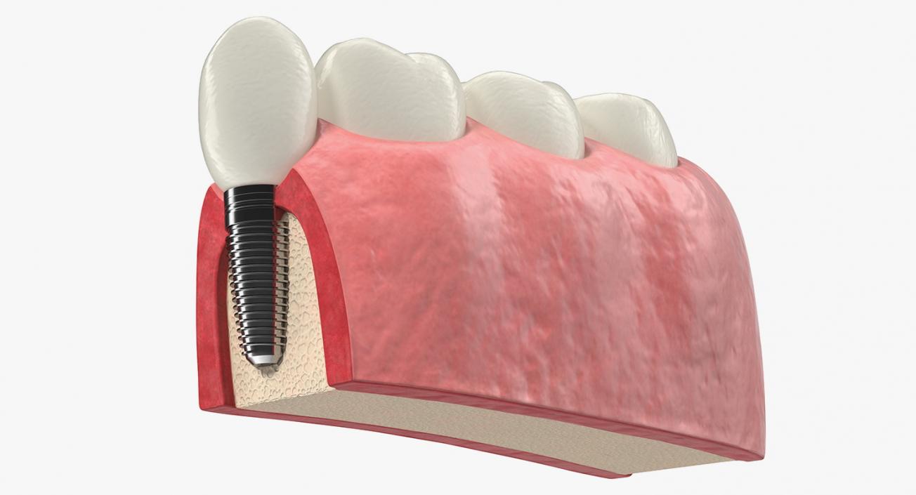 3D Education Tooth Implant model