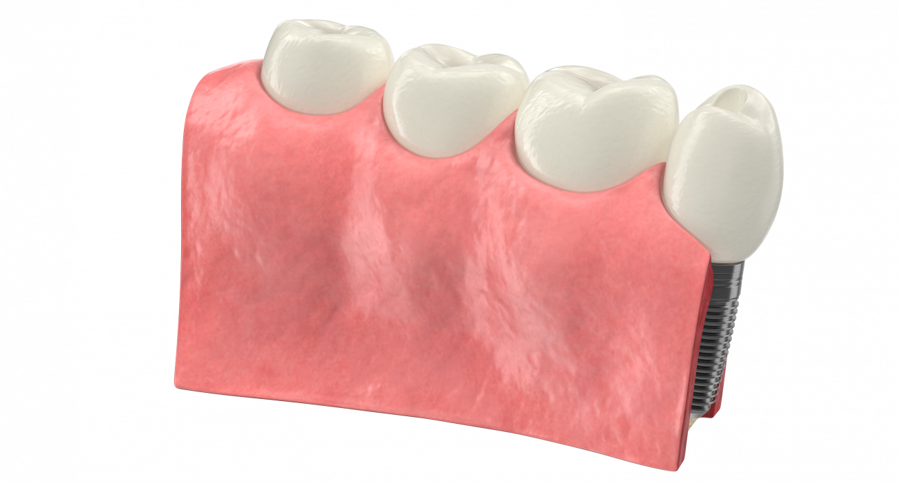 3D Education Tooth Implant model