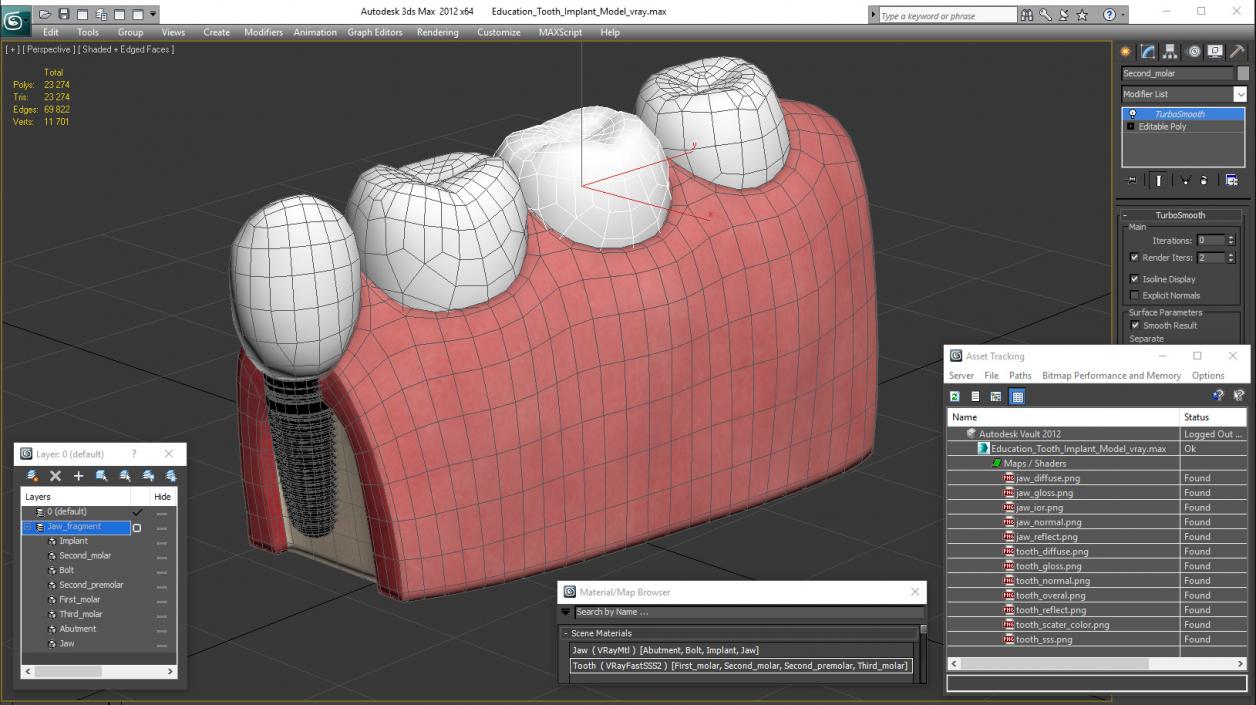 3D Education Tooth Implant model