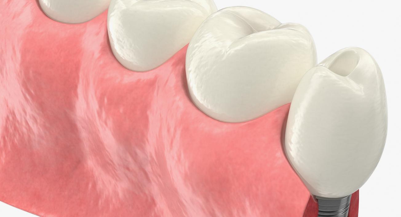 3D Education Tooth Implant model