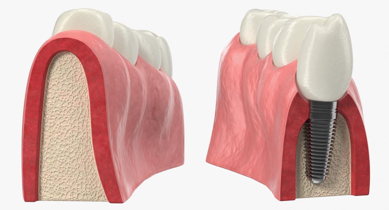 3D Education Tooth Implant model