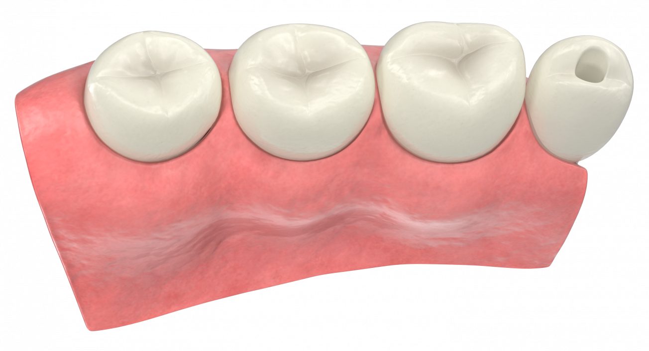 3D Education Tooth Implant model