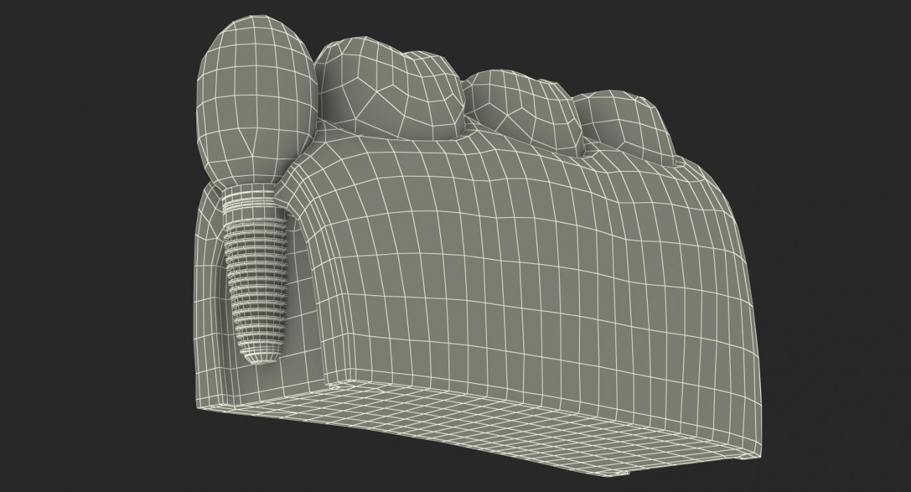 3D Education Tooth Implant model