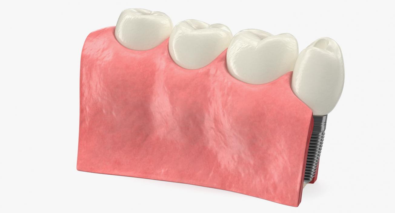 3D Education Tooth Implant model