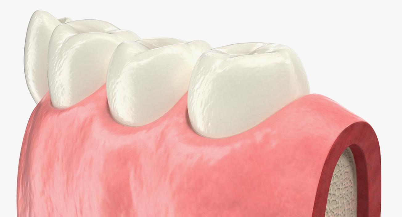 3D Education Tooth Implant model