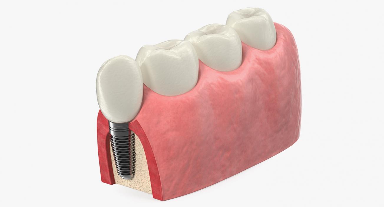 3D Education Tooth Implant model