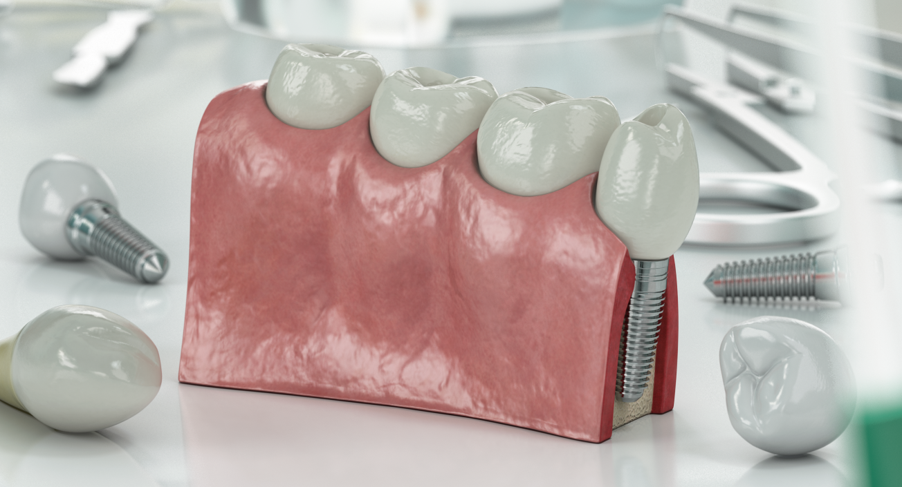 3D Education Tooth Implant model