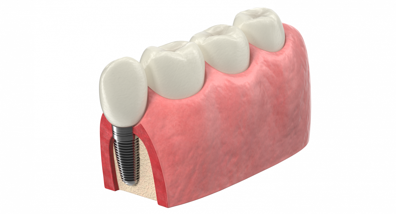 3D Education Tooth Implant model