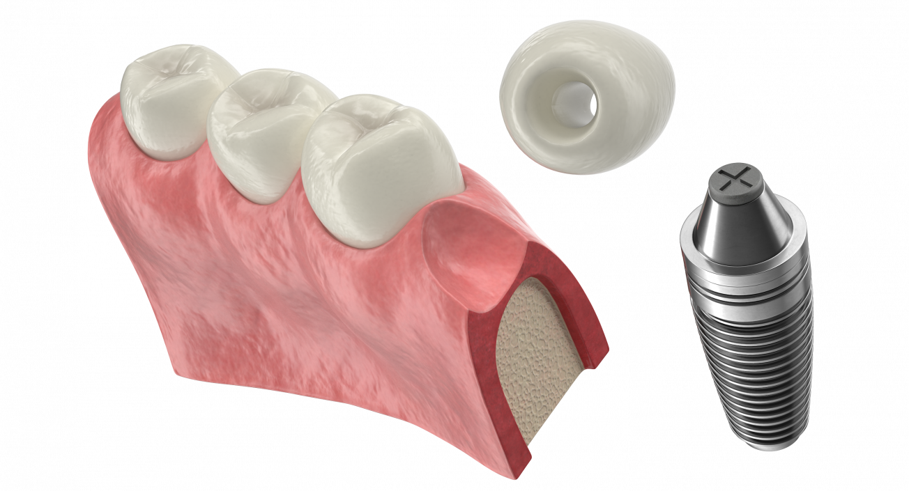 3D Education Tooth Implant model