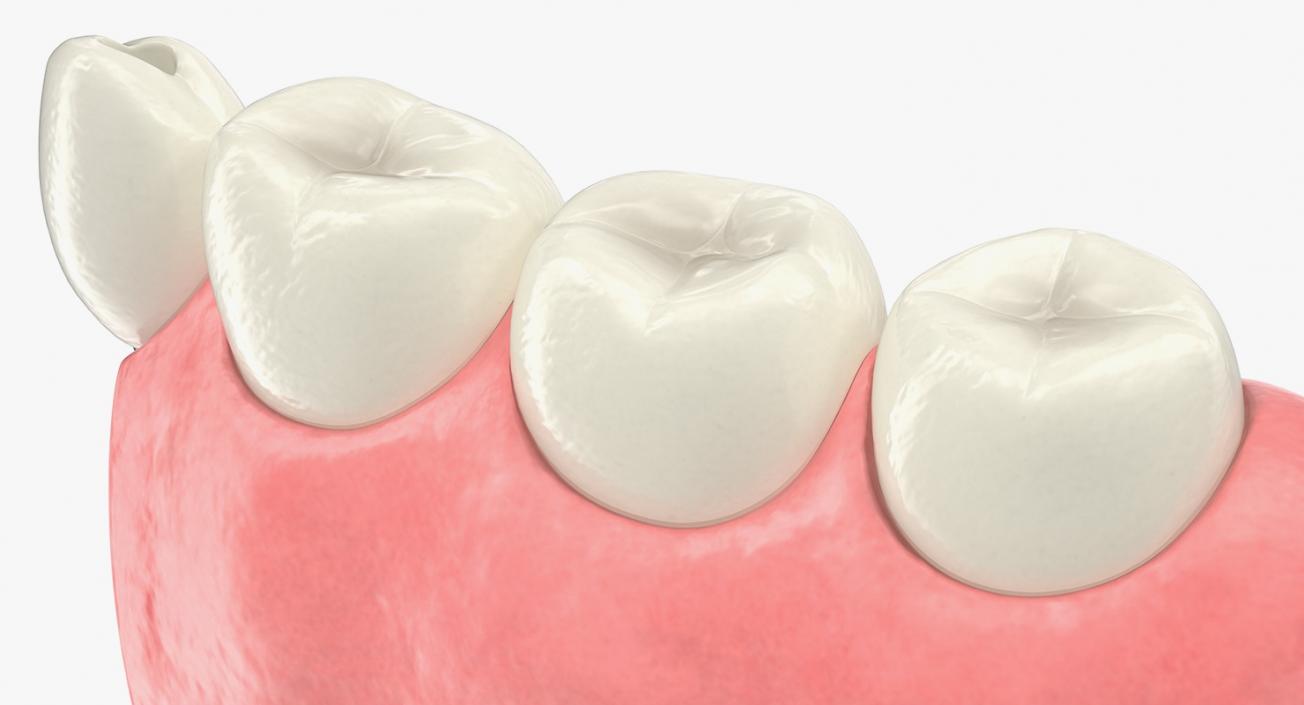 3D Education Tooth Implant model