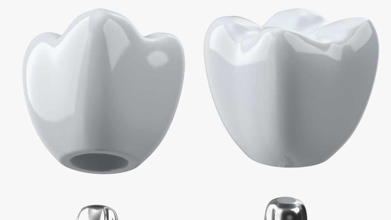 3D model Zygomatic Dental Implants