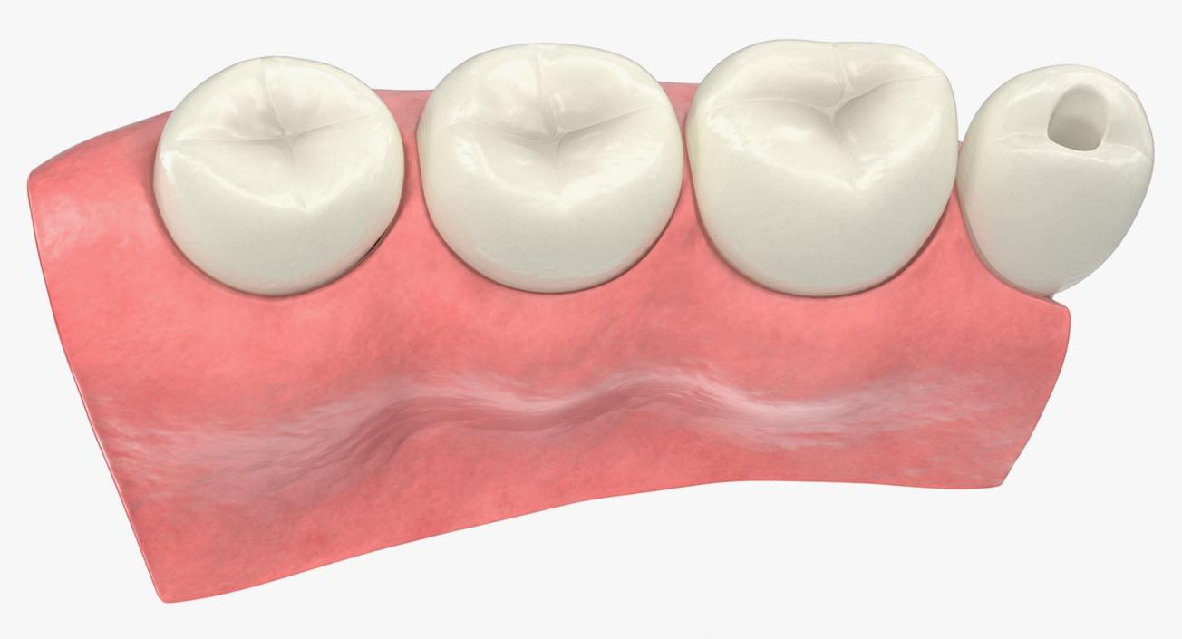 Tooth Implants Collection 3 3D