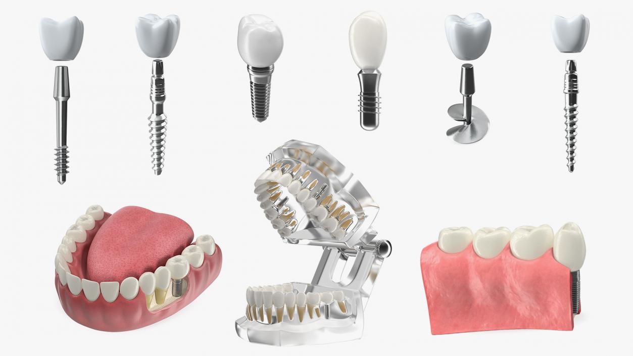 Tooth Implants Collection 3 3D