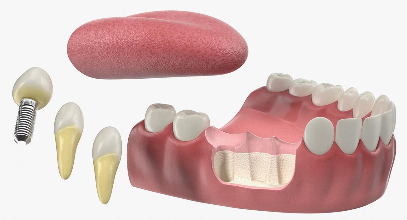 Tooth Implants Collection 3 3D