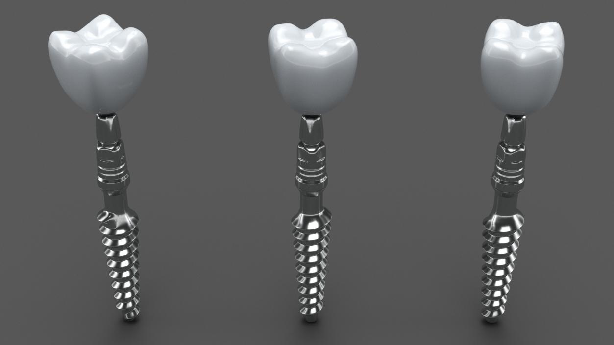 Tooth Implants Collection 3 3D