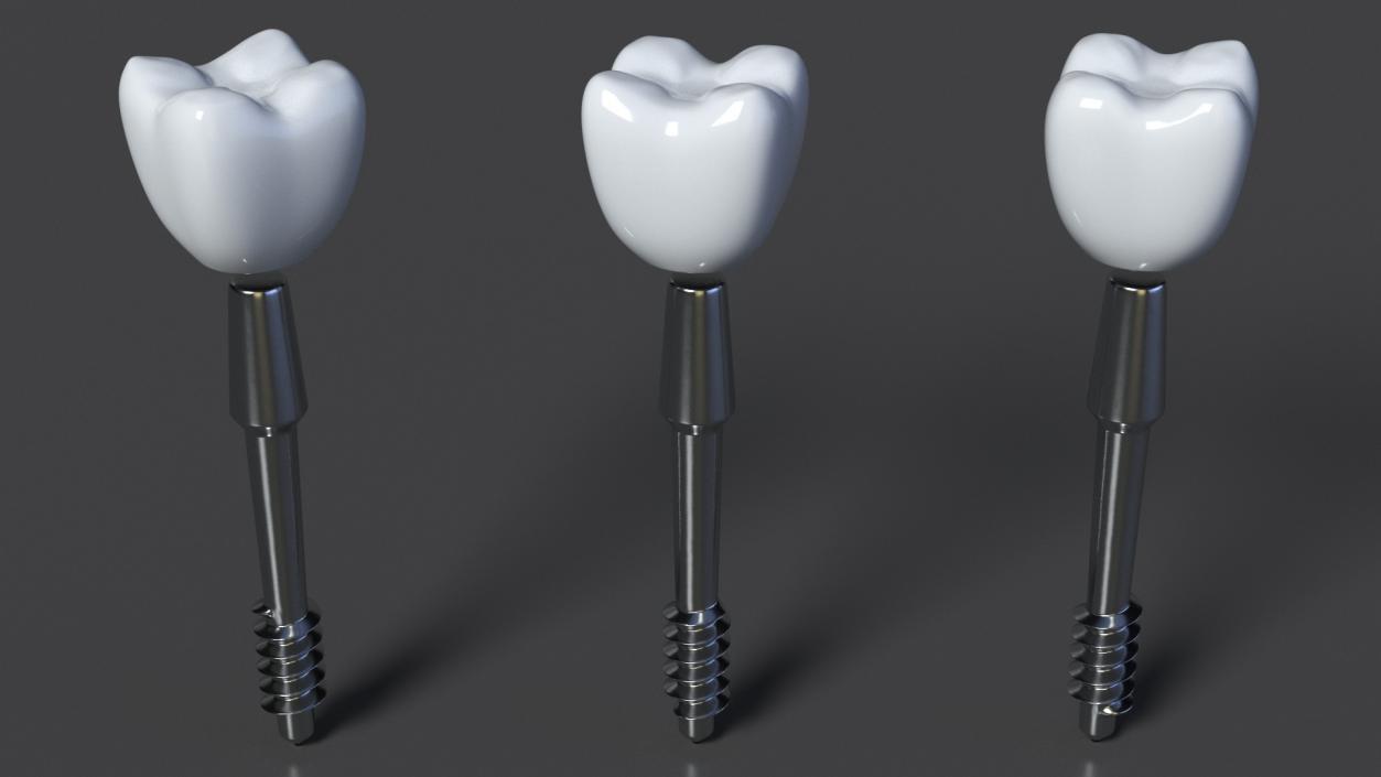 Tooth Implants Collection 3 3D